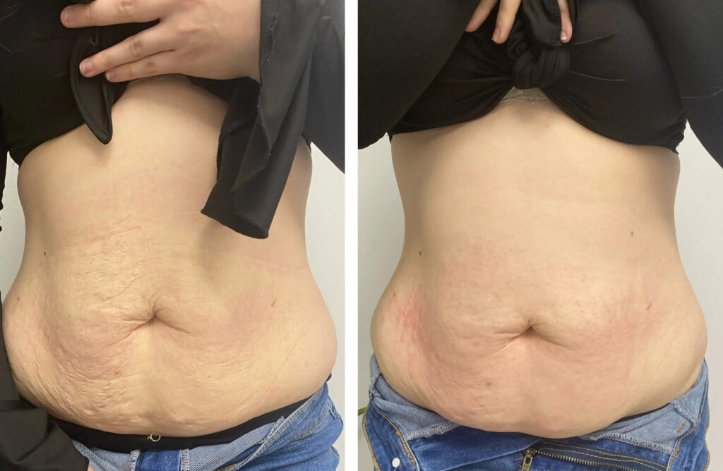 Radiofrequency Skin Tightening Before & After