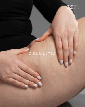 Protocolo “Cellulite Slayer” – Programa Integral de Remodelación Corporal