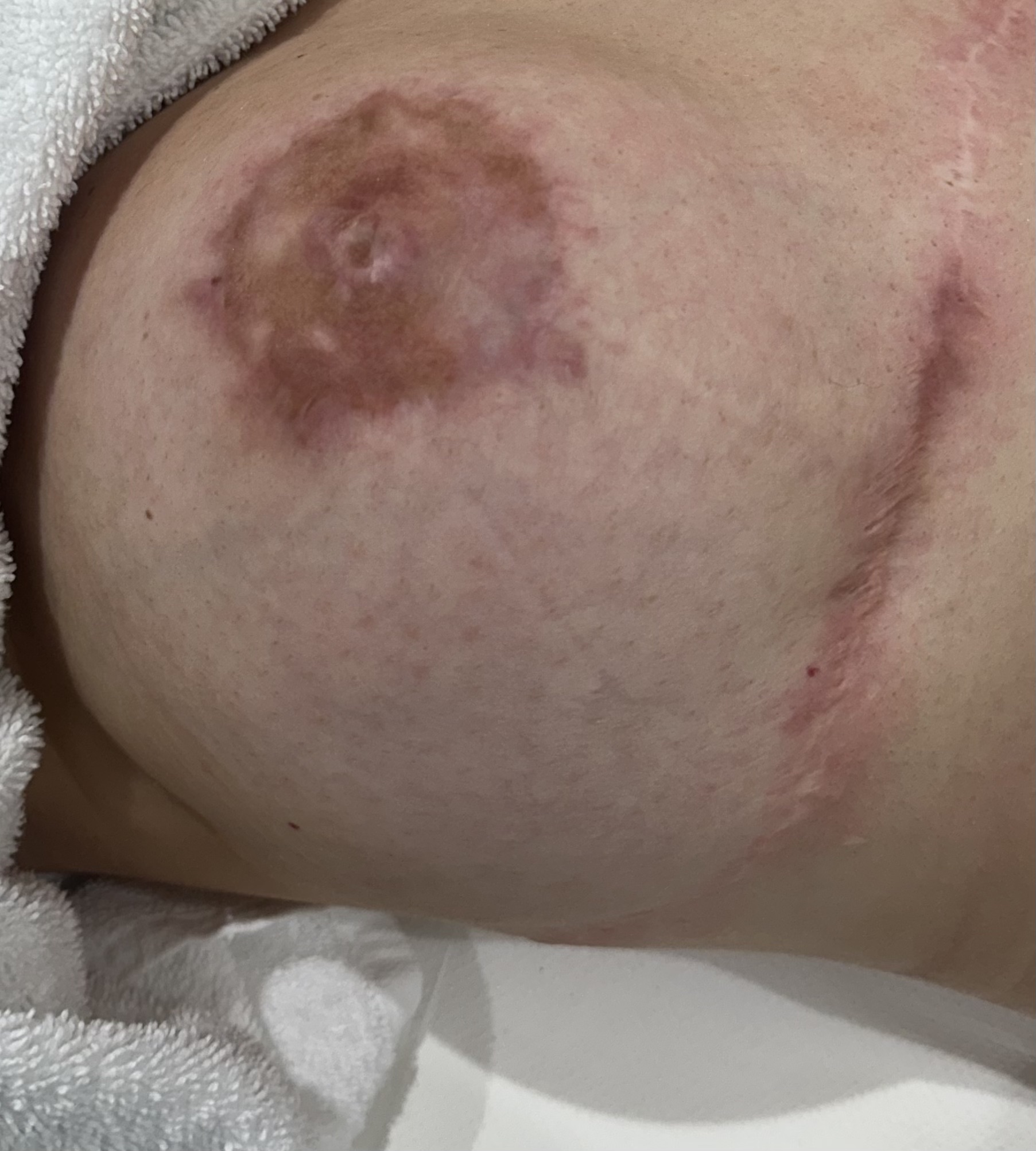 Atrophic scar example