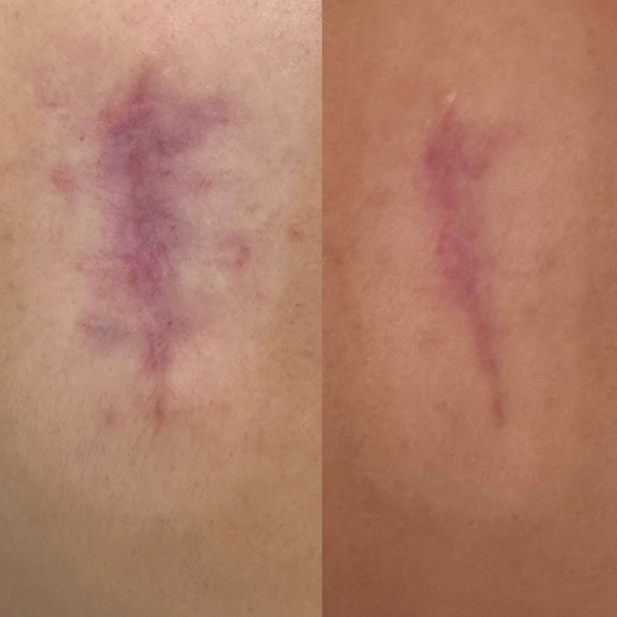 Normotrophic scar example