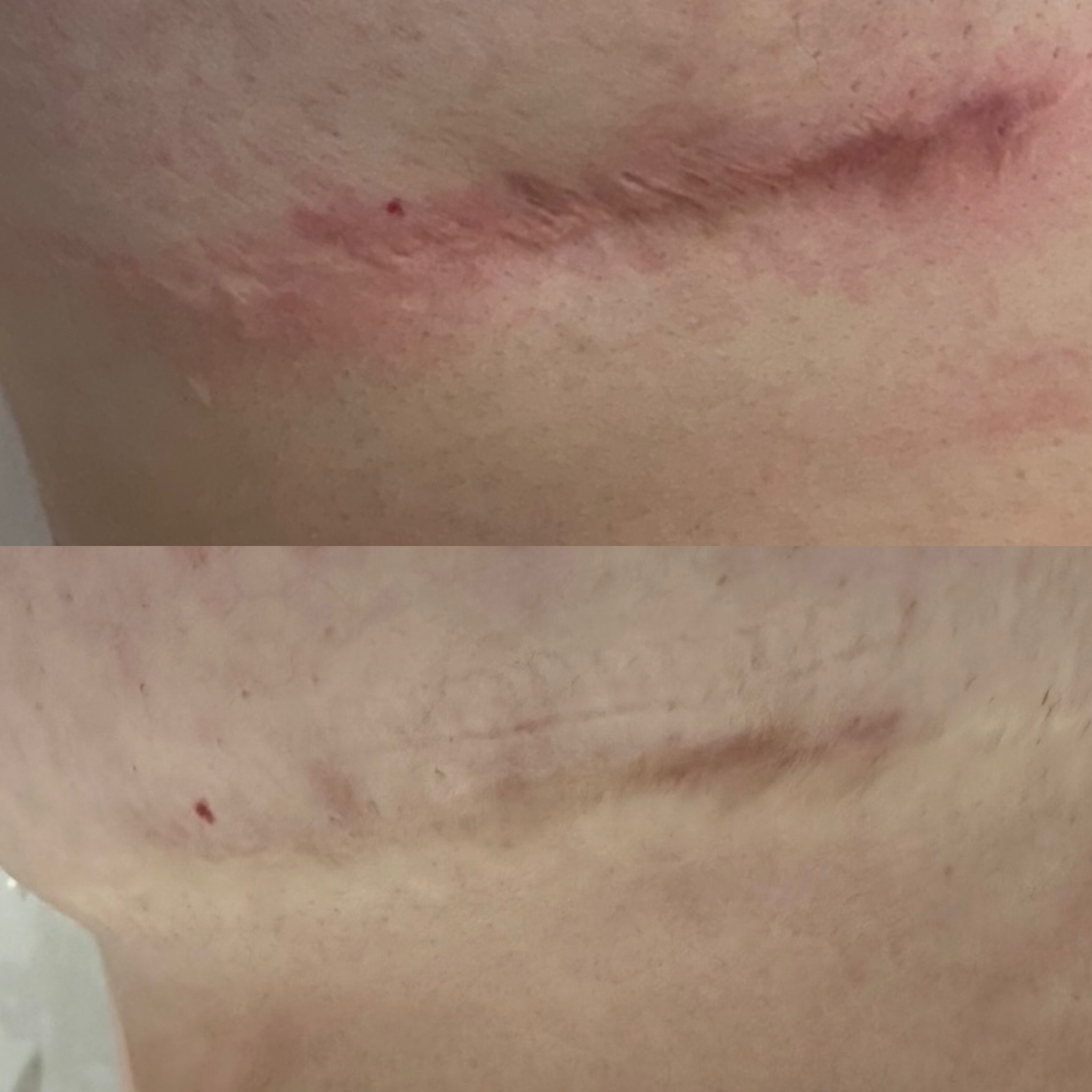 Scar follow up and skin care