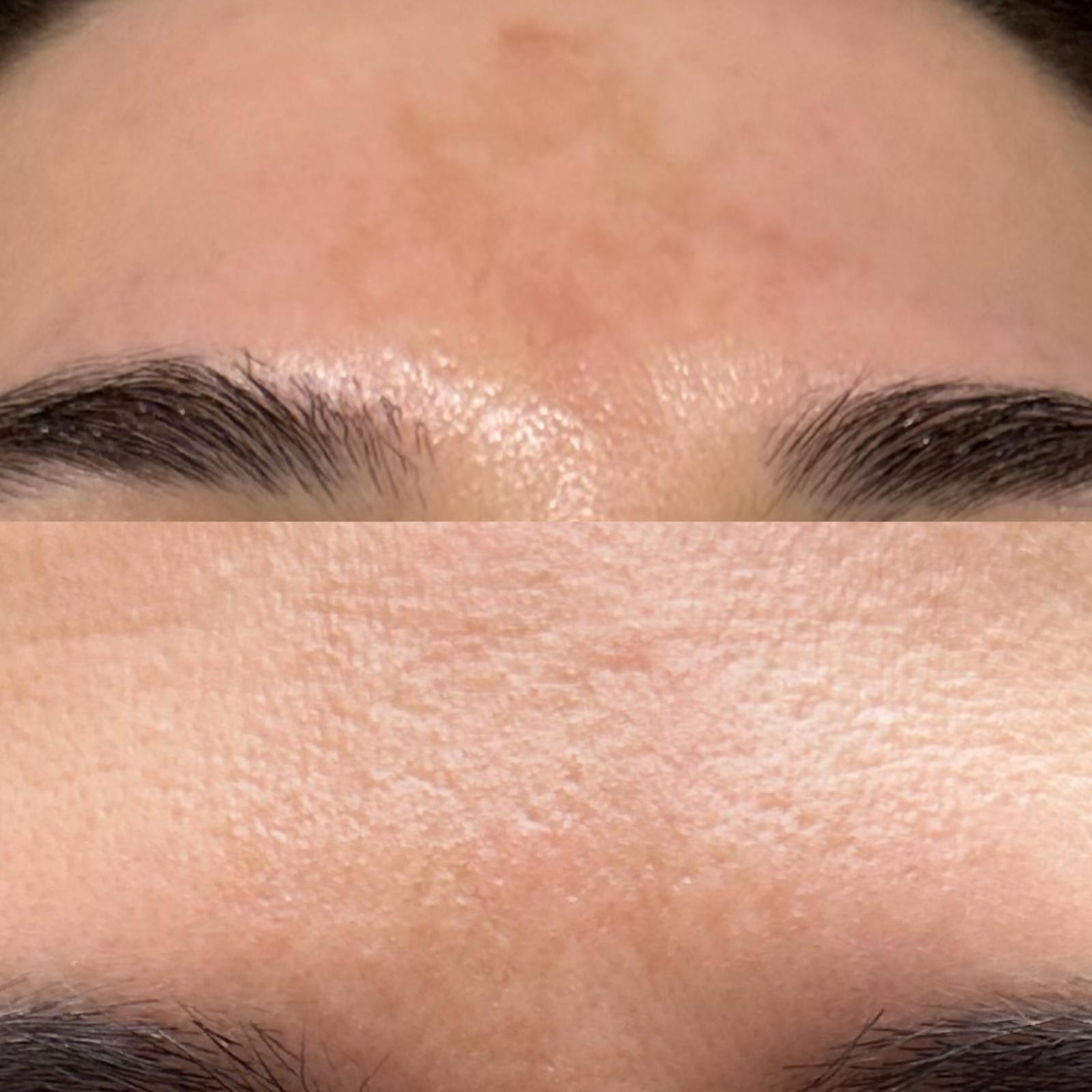 Scar remodeling timeline