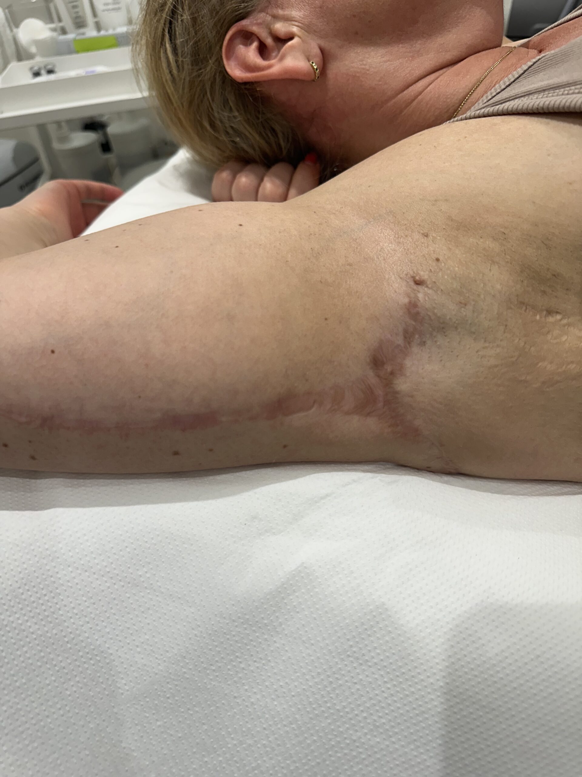 Hypertrophic scar example