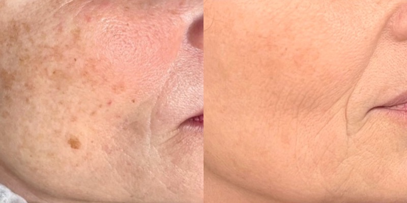 Áreas de tratamiento cutáneo avanzado con láser