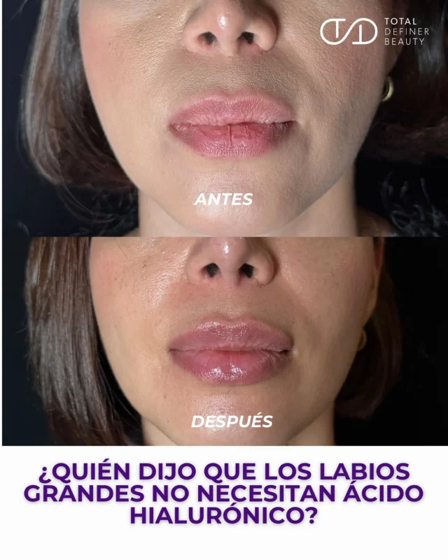 ¿Quién dijo que los labios grandes no necesitan ácido hialurónico?

La belleza no está en el volumen exagerado, sino en la armonía, la hidratación y esa definición sutil que transforma sin que nadie note por qué te ves tan bien.

Los labios naturales también se diseñan.
Y eso es justo lo que hacemos: realzamos lo que ya es bello, sin perder tu esencia.

Agenda tu cita y déjate enamorar por el arte de lo sutil.

#labiosnaturales #ácidohialurónico #lipdesign #armoníafacial #medicinaestética #labiosperfectos #beautywithpurpose
