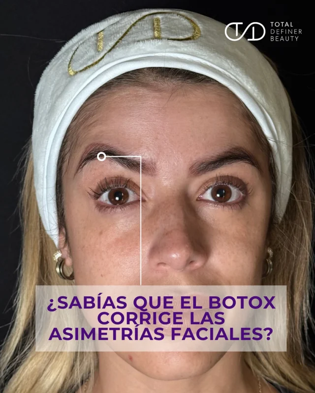 ¿Sabías que el Botox no solo suaviza arrugas? También corrige asimetrías faciales.
Pequeñas diferencias naturales entre un lado y otro del rostro —en cejas, sonrisa o líneas de expresión— pueden acentuarse con el tiempo.
El Botox, aplicado estratégicamente, permite equilibrar la fuerza de los músculos y devolverle armonía y simetría a tu expresión.
Resultados sutiles, naturales… y un rostro que refleja tu mejor versión.

La belleza no está en la perfección absoluta. Está en el arte de lograr un equilibrio real.
