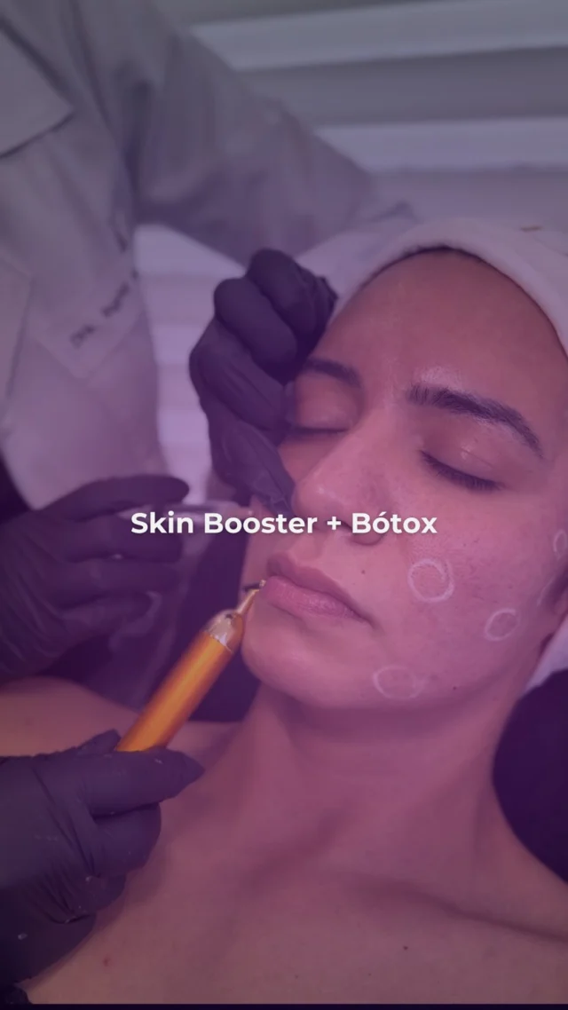 La belleza real no se impone, se revela.
Hoy nuestra paciente confió en nosotros para resaltar su luminosidad natural con un Skin Booster que hidrata desde adentro, y un toque de Botox que realza su expresión manteniendo toda su frescura.

Resultados sutiles, elegantes y profundamente auténticos.
Porque cuidarse también es un acto de amor propio.
_

#skinbooster #botox #bellezaconsciente #armoníafacial #cuidadodelapiel #totaldefiner #rejuvenecimientonatural