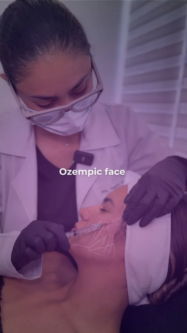 Ozempic y otros medicamentos similares han revolucionado el tratamiento para la pérdida de peso. Sin embargo, muchos pacientes han notado un efecto secundario inesperado: el “Ozempic face”. Al perder peso rápidamente, especialmente en personas mayores de 30, también se pierde grasa facial, lo que puede generar flacidez, hundimiento y una apariencia más envejecida o cansada.

Aquí es donde entra Sculptra, uno de nuestros tratamientos estrella. A diferencia de otros rellenos, Sculptra no solo da volumen: estimula la producción natural de colágeno con resultados progresivos y duraderos. Es como activar un proceso interno de regeneración que redefine el rostro desde adentro hacia afuera.

¿Perdiste peso pero no quieres perder tu armonía facial?
Sculptra te devuelve lo que el tiempo (y Ozempic) se llevaron.

Agenda tu valoración hoy y descubre cómo recuperar la firmeza y armonía de tu rostro de forma natural y progresiva.
Tu piel puede verse tan bien como te sientes.

Escríbenos y comencemos tu transformación.