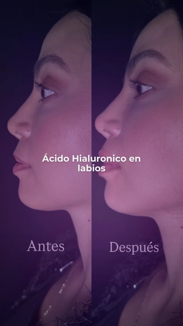 La proyección del labio superior puede transformar por completo el equilibrio del rostro.
En este caso, nuestra paciente presentaba un labio superior plano, con poca definición, lo que generaba una expresión más rígida y menos armónica.
Con una técnica precisa y natural de ácido hialurónico, logramos darle volumen, proyección y contorno, sin perder la esencia de su rostro.
El resultado: una sonrisa más suave, un perfil más equilibrado y una expresión más femenina y segura.
La belleza está en los detalles… y en labios que por fin se sienten completos.

Agenda tu valoración y descubre cómo un pequeño cambio puede hacer una gran diferencia.