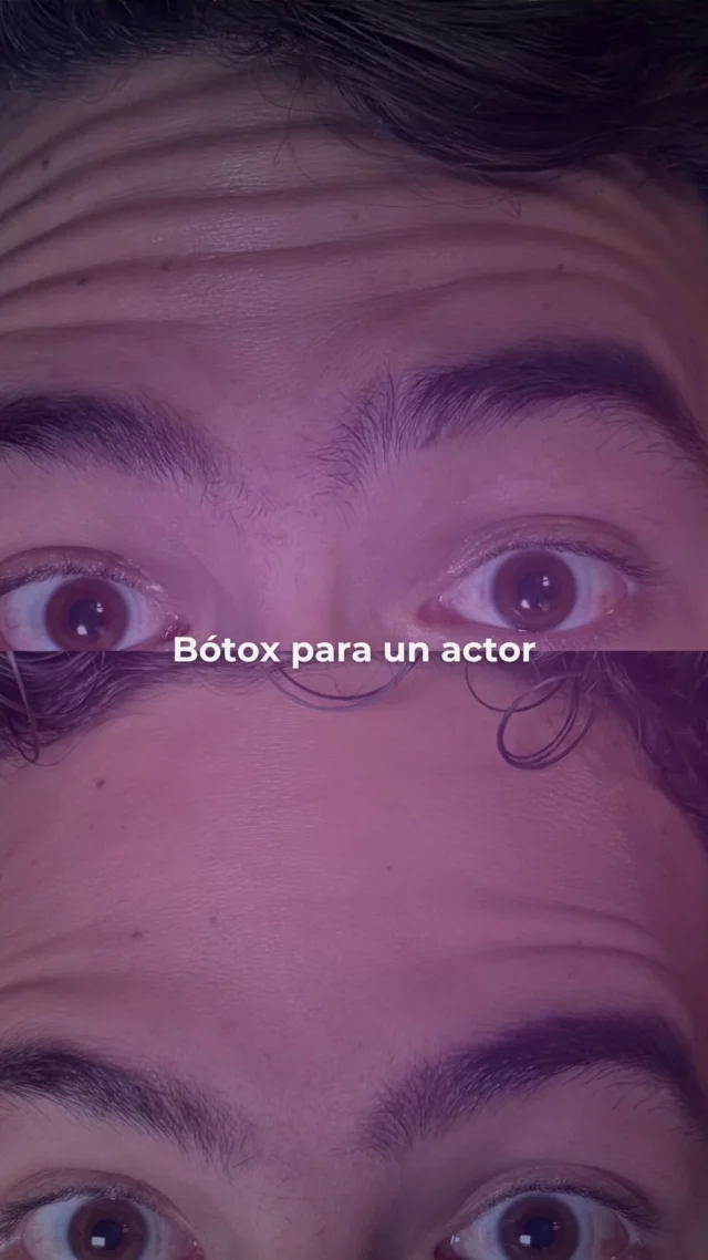 Nuestro paciente decidió aplicar Botox de forma preventiva y estratégica. El objetivo no era cambiar su rostro, sino suavizar líneas, relajar la expresión y devolverle luminosidad a su mirada sin perder naturalidad.

Y así fue.

Resultados sutiles, efectivos y en total armonía con su esencia.
Porque el verdadero arte del Botox no está en congelar…
Está en liberar la expresión de tu mejor versión.

¿Quieres verte más fresco, descansado y seguro sin perder tu identidad?
Agenda tu cita con nuestro equipo experto y da el primer paso hacia una expresión más ligera, natural y renovada.